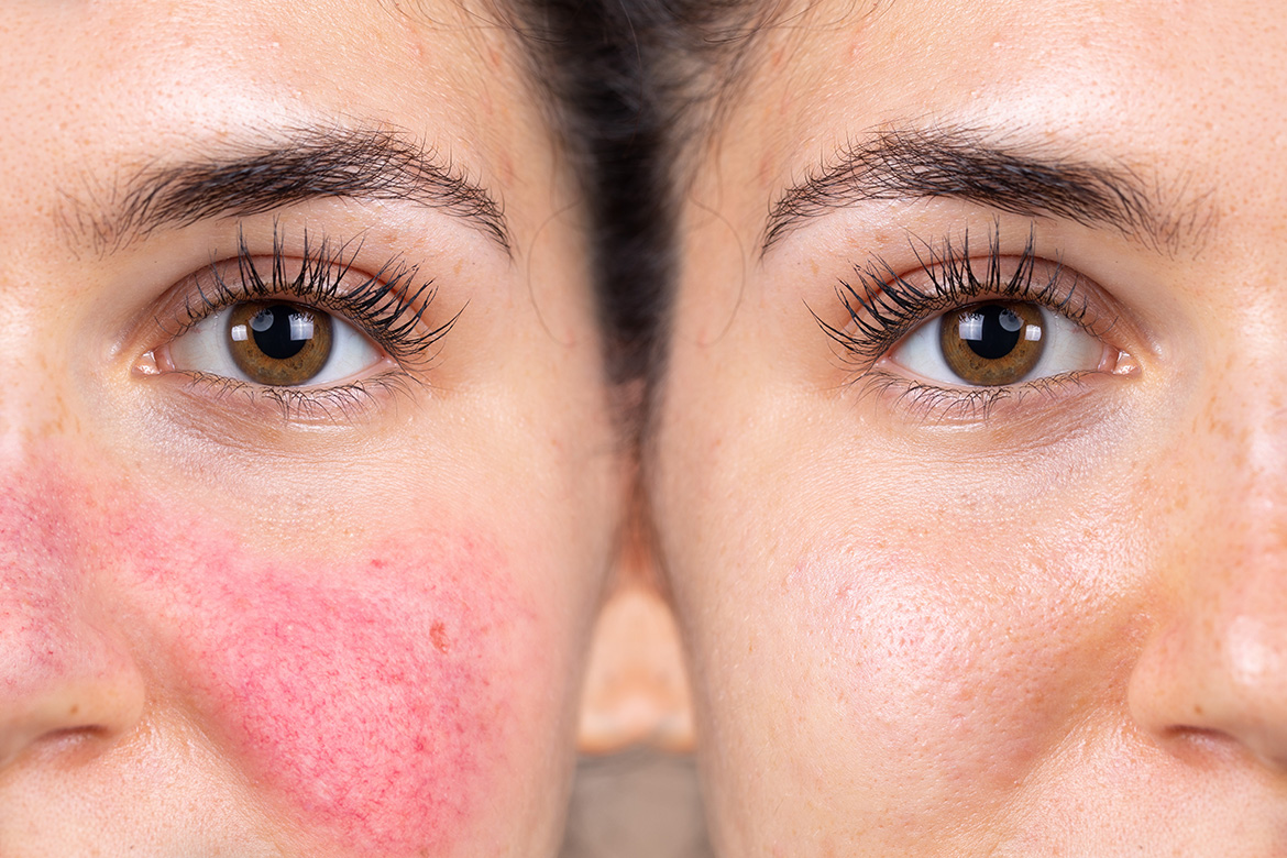 All You Need To Know About Rosacea 